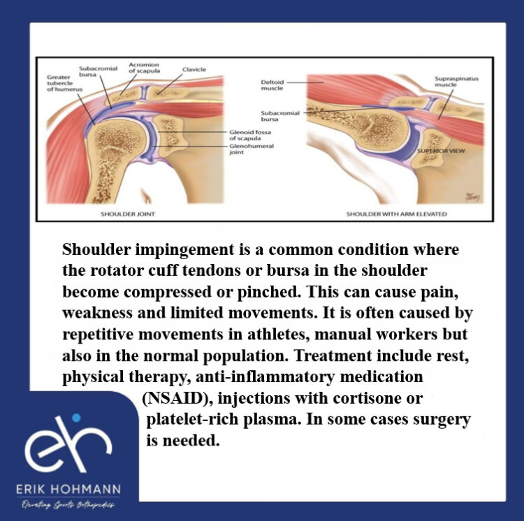 Shoulder impingement - Dr. Erik Hohmann