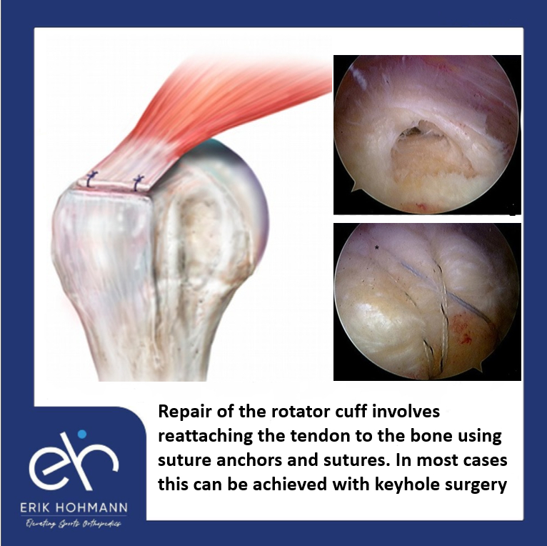 Repair of the rotator cuff