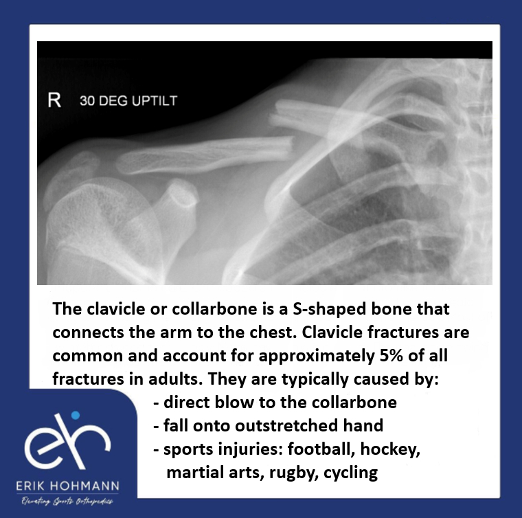 The clavicle or collarbone is a S-shaped bone that connects the arm to the chest.