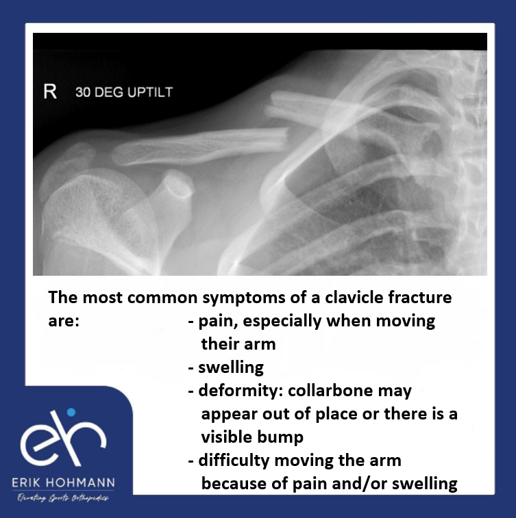 The most common symptoms of a clavicle fracture 