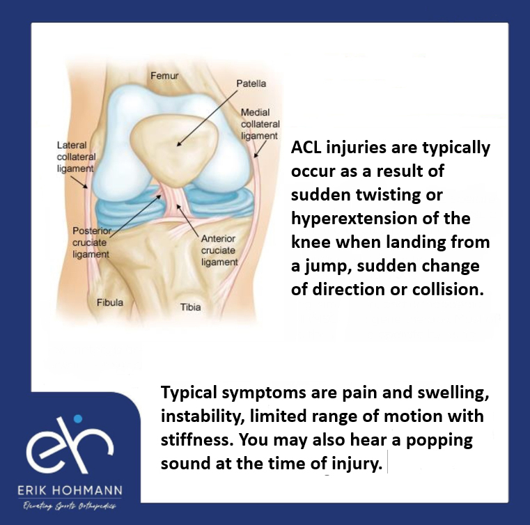 ACL injuries