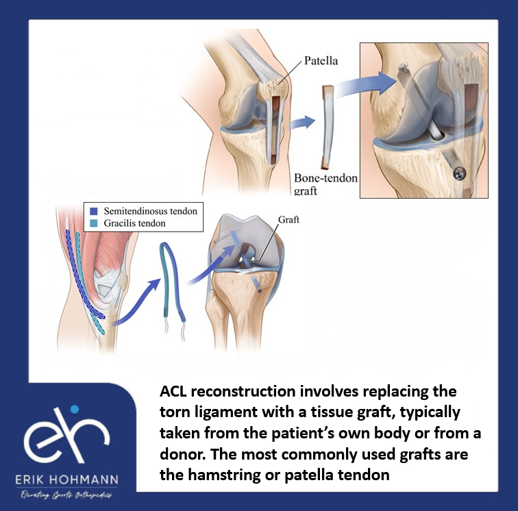 ACL reconstruction Dubai