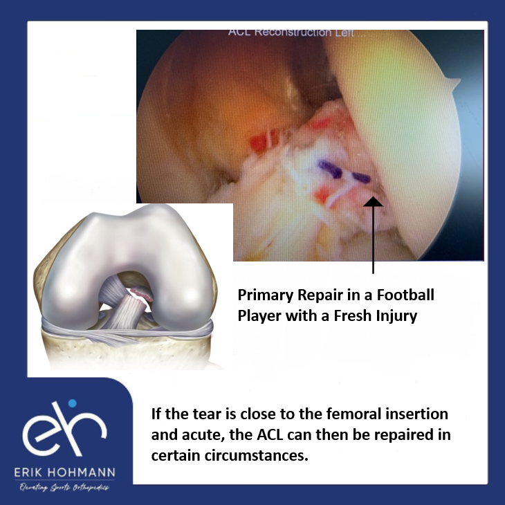 Primary Repair in a Football Player with a Fresh Injury